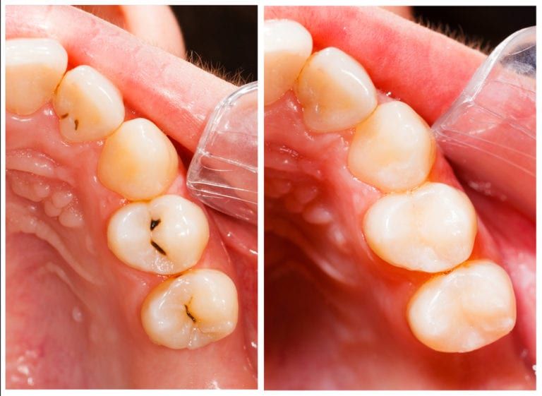 Composite-Tooth-Colored-Fillings-768x561